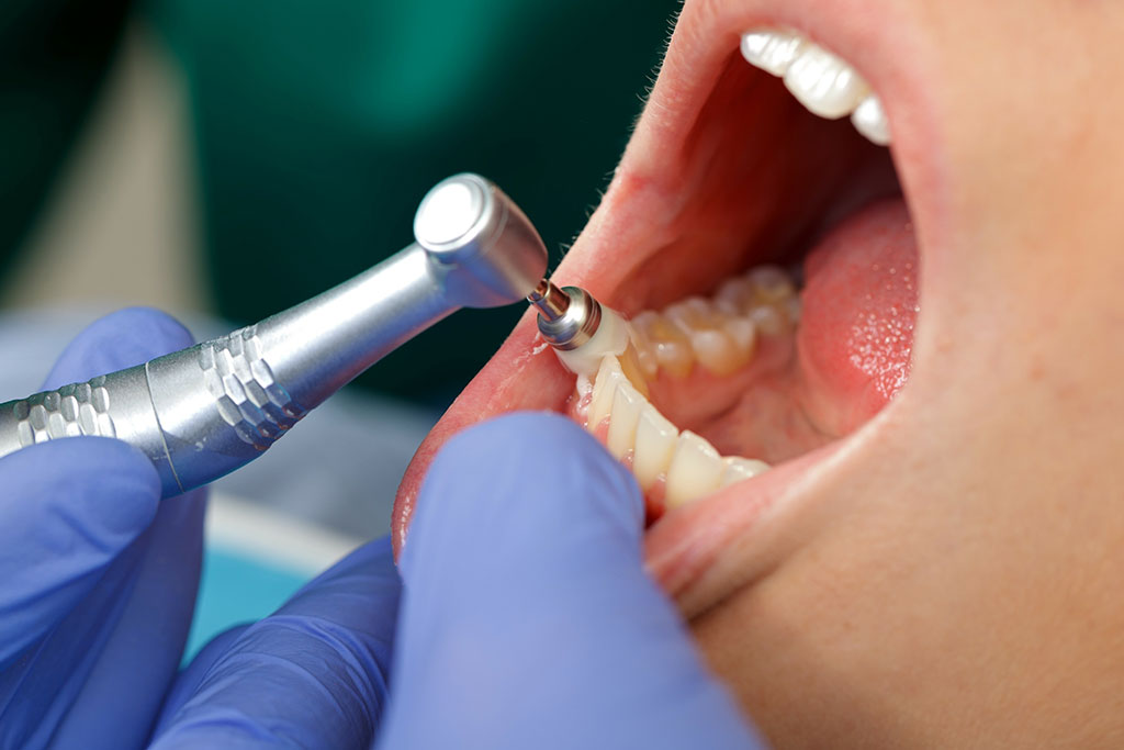 Dental Cleaning Picture