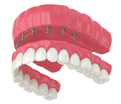 Removable Snap-On Full Implant Dentures