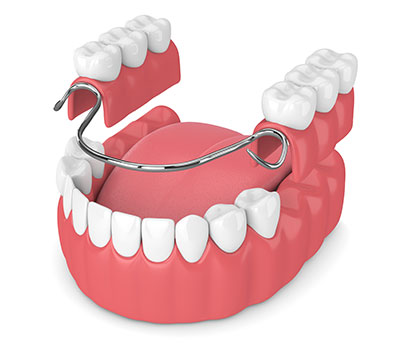 Removable partial dentures