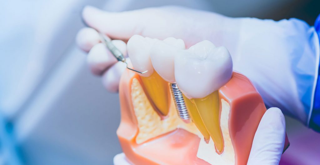 Dental implants and jawbone