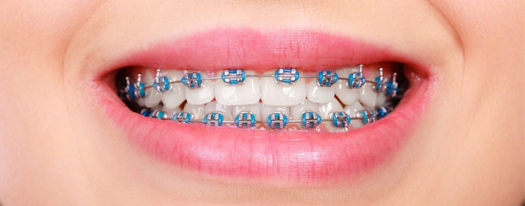 Orthodontics in South Gate