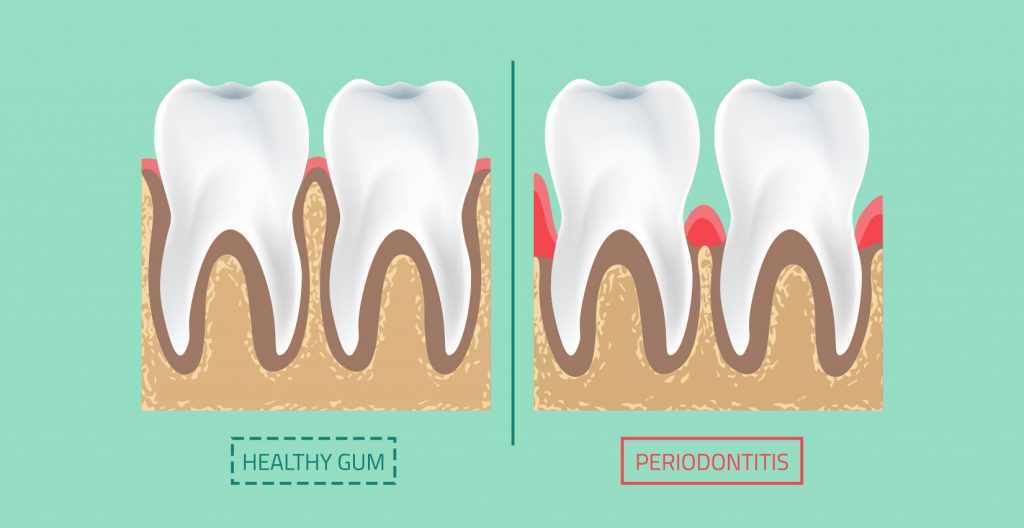 Gum Disease Periodontitis
