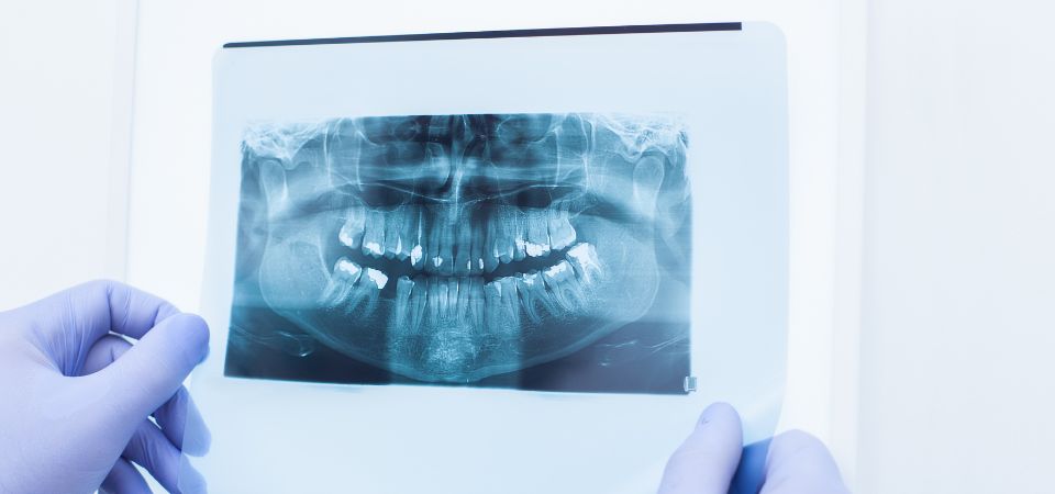 Dental X-ray before tooth extraction