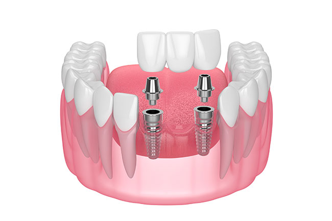 Multiple tooth Implant
