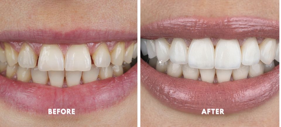 Before and after Dental Veneers in South Gate, CA