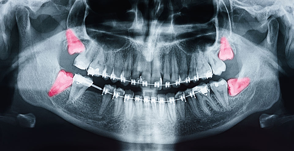 Wisdom teeth x-ray